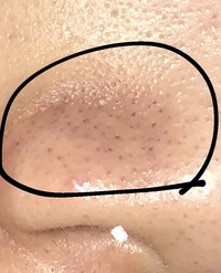 画像見てほしいです 皮脂が酸化して黒くなってるんです左右の鼻の付け根 ど Yahoo 知恵袋