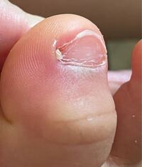 一歳の子供の足親指に爪 ささくれ が写真のようになってしまい 心 Yahoo 知恵袋