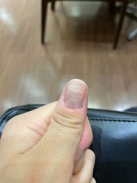 爪が何年か前から親指だけこんなふうにボコボコで傷だらけなのですが Yahoo 知恵袋