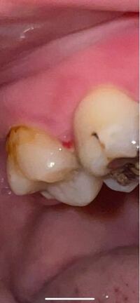 重曹うがい 歯茎