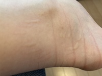 痒いです これは虫刺されでしょうか また何の虫か教えて欲しいです Yahoo 知恵袋