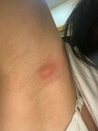 脇に大きめの出来物が出来ました 粉瘤ですか 一昨日に突然できました Yahoo 知恵袋