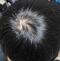 高校3年18歳です 白髪も増えてきて つむじも寂しくなってきた気 Yahoo 知恵袋