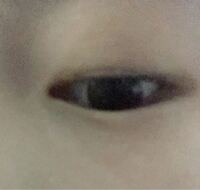 整形したいです 切開か埋没か悩んでますが この目だとどちらがいい Yahoo 知恵袋