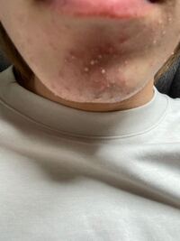 閲覧注意最近顎周りに白ニキビが大量に出来ました スキンケアとしては朝はお湯 Yahoo 知恵袋