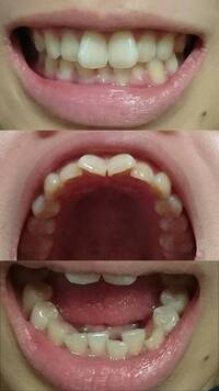 画像あります 上の真ん中の前歯2本が内側に傾いた状態で本来は見え Yahoo 知恵袋