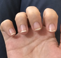 画像の通り 昔から爪の白い部分とピンクの境目 イエローライン がガタガタ Yahoo 知恵袋