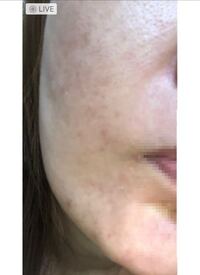 こういう薄いシミはレーザーで剥がせないっていわれたんですけど なら どうし Yahoo 知恵袋