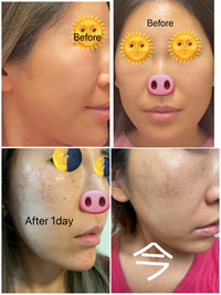 ピコレーザー後の色素沈着について4 23に 皮膚科にて鼻の横に Yahoo 知恵袋