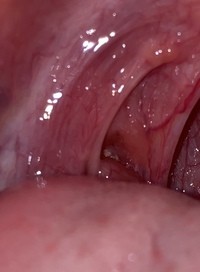 画面の中央の少し見えてるちょっと白っぽいのが膿栓です どうやった Yahoo 知恵袋