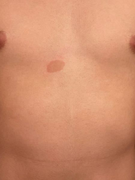 胸と胸の間のあたりに大きなシミがあり 去年と比べると大きくなっているように Yahoo 知恵袋