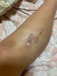 閲覧注意 足の火傷についてです 二日前に電源が入ったコテの上に体重 Yahoo 知恵袋