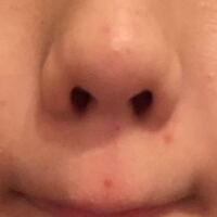 中三女子です 写真閲覧注意です 写真の鼻下の赤いてんてんの Yahoo 知恵袋
