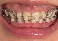 19年10月から矯正開始しました 来月には装置を外してリテーナーに移る Yahoo 知恵袋