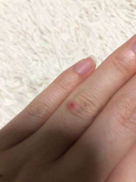 指のイボについて - 指に大きいイボがあり、2週間程前に皮膚科で 