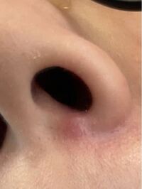 鼻の穴の下に赤い腫れたものが 痛いです 鼻をかむのがつらい 病院に行 Yahoo 知恵袋