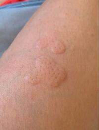 汚くてすみません 先月くらいからこのように謎の湿疹 ができます かゆ Yahoo 知恵袋