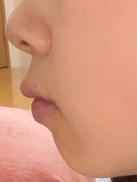 このような横顔がコンプレックスです Eラインに近づけるにはやはり顎を Yahoo 知恵袋