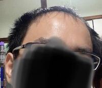 結婚を考えている彼が薄毛です 正直ハゲ嫌いな親に紹介するの Yahoo 知恵袋