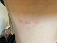 かゆいです かぶれですか ダニですか 彼氏も同じところに同じように出来てい Yahoo 知恵袋