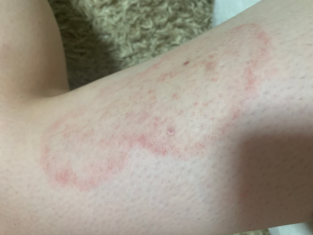 皮膚の病気 アトピー 解決済みの質問 Yahoo 知恵袋