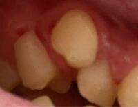 閲覧注意です 八重歯の歯茎がすごい腫れています こういうのって Yahoo 知恵袋