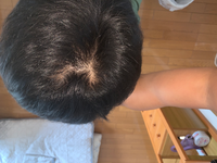 22歳でこんな感じです つむじが２つあり余計薄く見えます 女性の方に質問で Yahoo 知恵袋