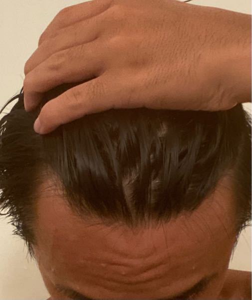 これってハゲてますか 最近前髪が薄くなってもともとおでこは広かったんです Yahoo 知恵袋