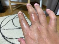 アルカリ性洗剤の原液が皮膚に10分程度付着し 肌がただれてきました Yahoo 知恵袋