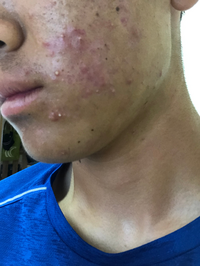 大きいニキビができたのですが どうすればなるべく早く跡にならず治りますか Yahoo 知恵袋