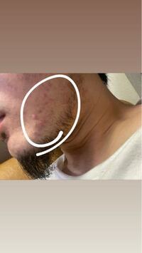 頬の左側だけあれます 右側は全く荒れていません しかもかな Yahoo 知恵袋