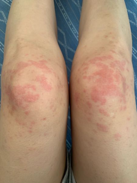 アレルギー ペニシリン 即時型でないペニシリンアレルギー疑いに対し皮膚検査はいらないかもしれない