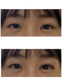 自分の目が離れ目で嫌いです 上の目はノーマルで撮って何もいじってない Yahoo 知恵袋