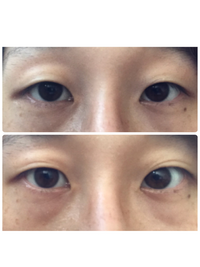 一重の重さについて一重について調べると 重い一重と軽い一重の2種類あるとの Yahoo 知恵袋