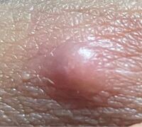 玉袋の中にしこり知恵袋