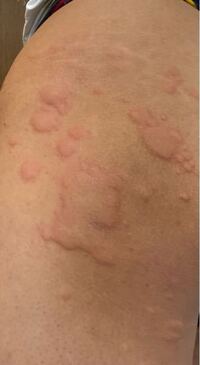 かれこれ10年ほどアトピーを患ってるのですが 最近アトピーの痒みがあまり出 Yahoo 知恵袋