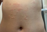 27歳女です お腹 腰回りがかぶれたようになってしまいました Yahoo 知恵袋