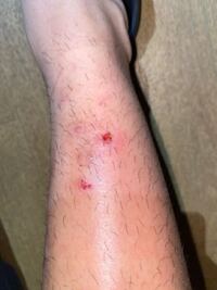 至急です 足がパンパンに腫れてとても痛く 痒いです虫刺されでしょうか Yahoo 知恵袋