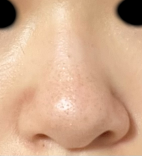 この鼻を綺麗にするのは無理ですかね 画像あります いちご鼻 左右非対称 ニ Yahoo 知恵袋