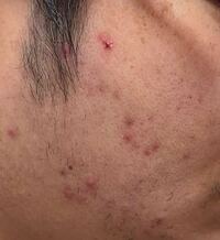 閲覧注意 5年くらい ずっと肌荒れがひどいです ニキビ Yahoo 知恵袋