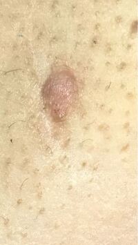 18歳女です 閲覧注意です 汚い脇ですみません この赤い豆くらいのも Yahoo 知恵袋