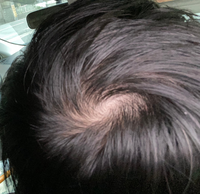 生まれつき細い髪で軟毛なんですが 薄毛かどうか教えて頂きたいです Yahoo 知恵袋