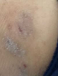 尻の肌荒れが治りません 皮膚科に2回行き 同じ薬で対応でした場所が場所 Yahoo 知恵袋