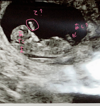 赤ちゃんの性別ベビーナブ11w2dのエコーです 男の子 女の子ど Yahoo 知恵袋