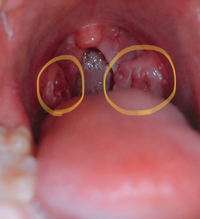これは咽頭がんの初期症状ですか 歯磨きの時にふと鏡を見たら今までないくらい Yahoo 知恵袋