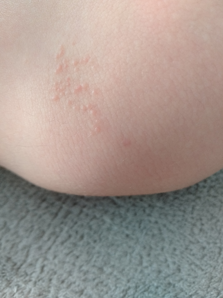 子供の膝に半年くらい前にブツブツ（痛み痒み無し）ができ、1ヶ月前 