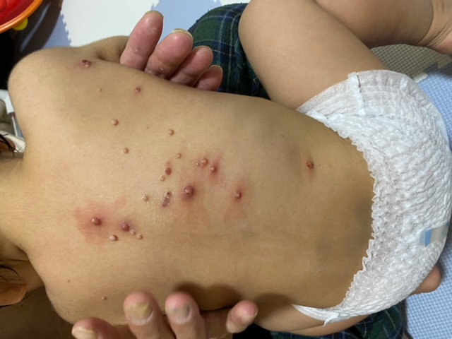 生後4ヶ月の頃から背中に水いぼができたのですが、1歳2ヶ月になり 