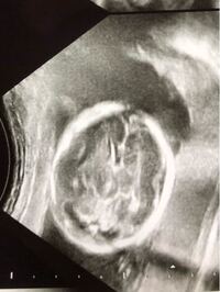 赤ちゃんのエコー写真の性別について教えてください この写真から性別がどちら Yahoo 知恵袋