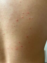 皮膚にできたブツブツについて質問です これはニキビでしょう Yahoo 知恵袋