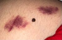 私が寝ている間 彼氏にキスマーク付けられました 昨日 そ Yahoo 知恵袋